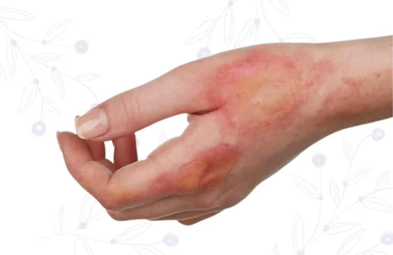 Reconstrucción por quemaduras